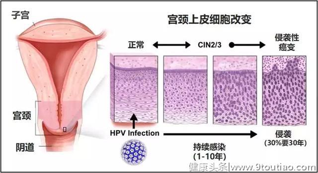 HPV感染=不检点？请警惕这三种性生活方式！