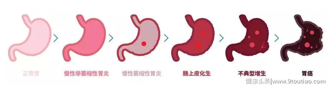 一半中国人都有，这种胃癌前病变的诱因