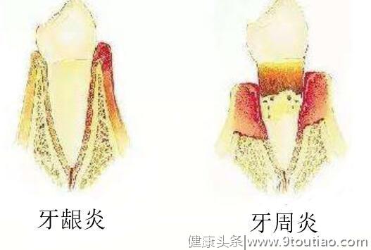 口腔出血是什么原因？怎么办呢？