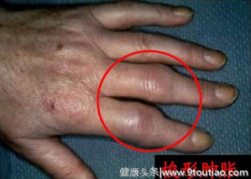 手指发生这种改变意味着可能患有骨关节炎，医生教您如何自检