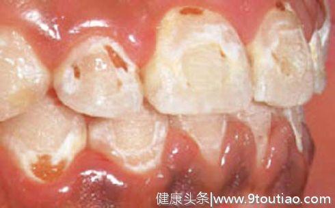 矫正牙齿有什么副作用？