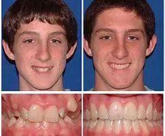 矫正牙齿有什么副作用？