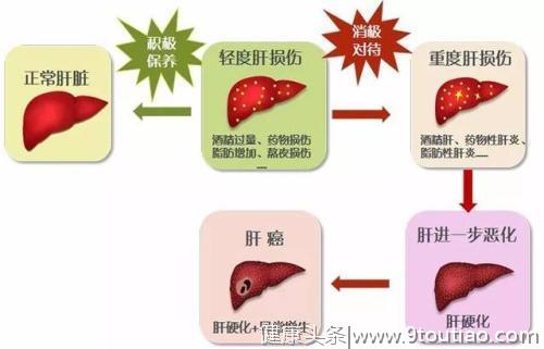 炎症是引起肝癌的关键因素，这种蛋白质可以抗炎减少肝脏炎症