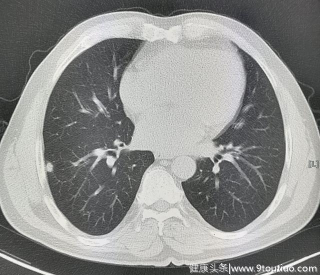 肺结核会不会引起肺癌？