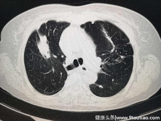 肺结核会不会引起肺癌？