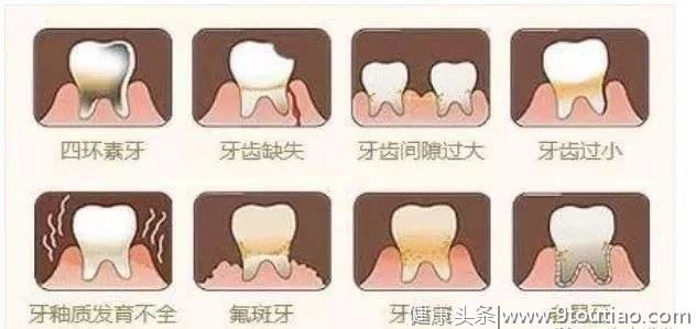 牙贴面修复美白 让牙齿变美更简单…
