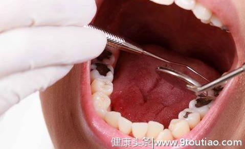 牙齿上出现黑线别疏忽，它可能会损坏你的牙齿