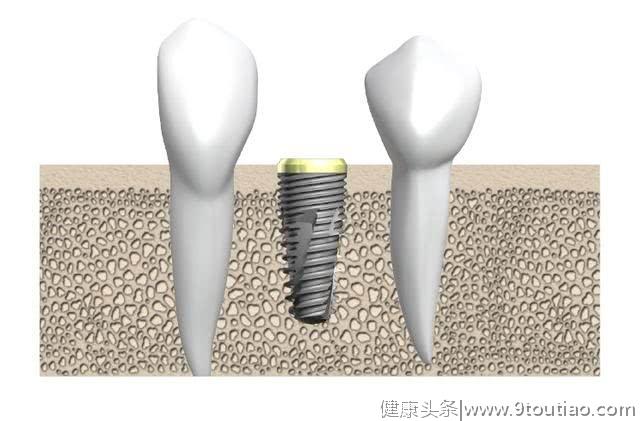 种植牙黑科技，让每一位牙医都能轻松开展种植项目