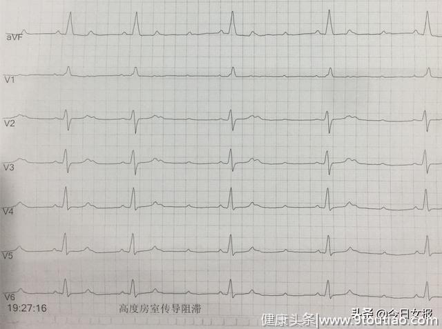 18岁少女感冒后心率骤降！医生：这个病20岁少年比80岁老人更危险