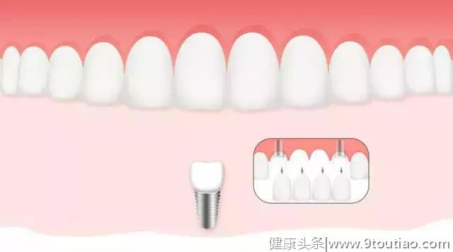 牙齿变长牙缝变宽...注意！你的牙龈正在萎缩！