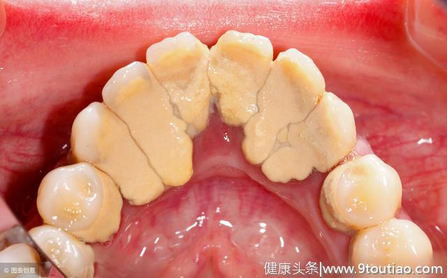 牙齿根部总是有黄白色污垢，软软的还发出恶臭，这是病吗？