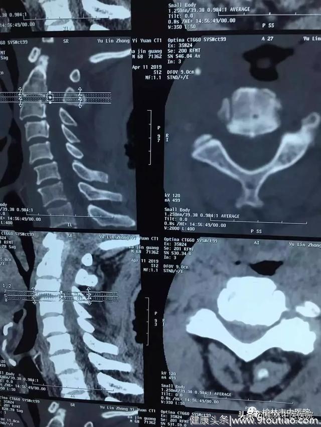 榆林中医院实施首例复杂性颈椎病手术
