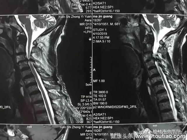 榆林中医院实施首例复杂性颈椎病手术