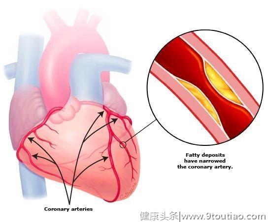 冠心病系列：冠状动脉性心脏病的基础知识