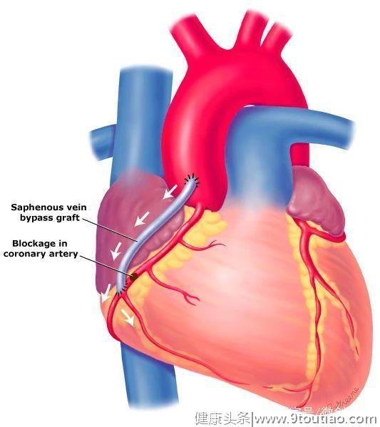 冠心病系列：冠状动脉性心脏病的基础知识