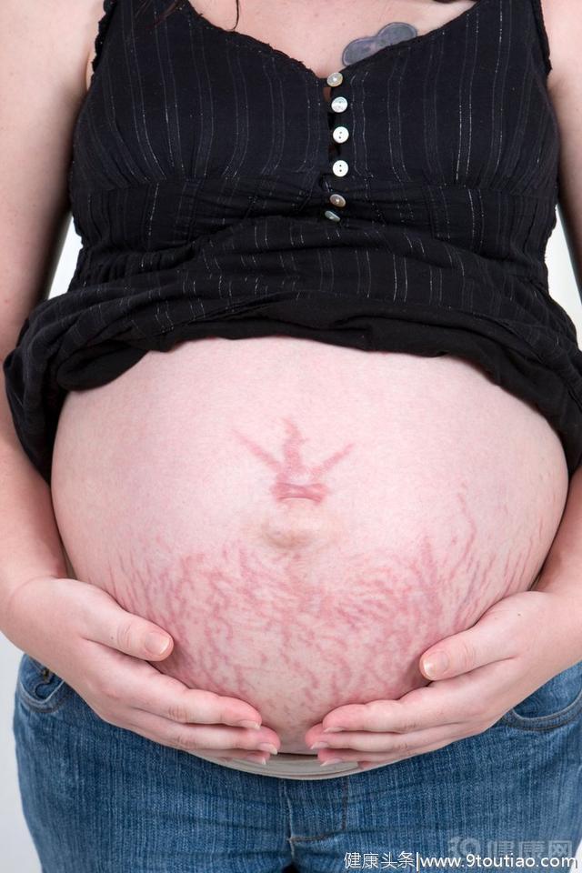 怀孕了也要美美的，4个方法帮你拒绝妊娠纹，值得一试