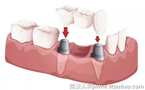 科普：种牙后患者需要怎么做，才能让种植牙更耐用？