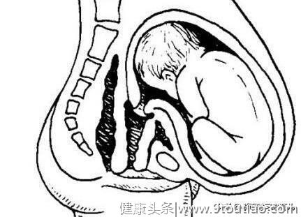 怀孕了，肚子增大明显，后面看不出怀孕，有可能是悬垂腹，需谨慎