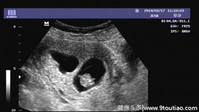 怀孕50天的孕囊，能根据B超单上的数据，看出胎宝宝的性别吗？