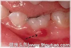 孩子嘴里出现小水疱、双排牙等异常，该如何处理？葉子口腔科普