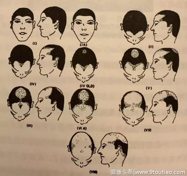 中国人脱发年龄提前20年 ？人类还存在，就摆脱不了脱发