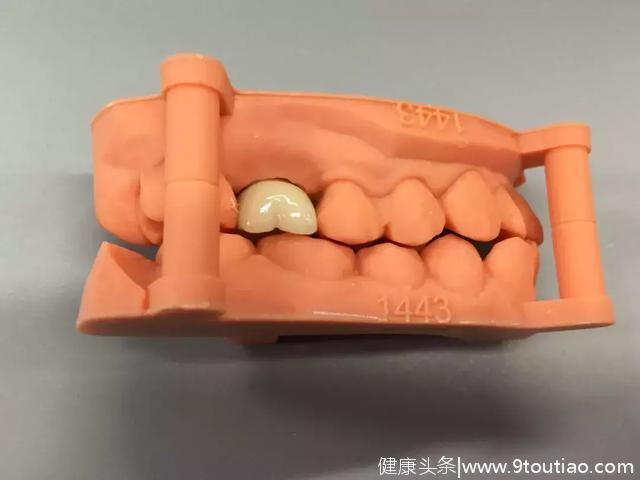 【直播课程】靖佳齿科专利技术教您10分钟精准转移种植修复模型