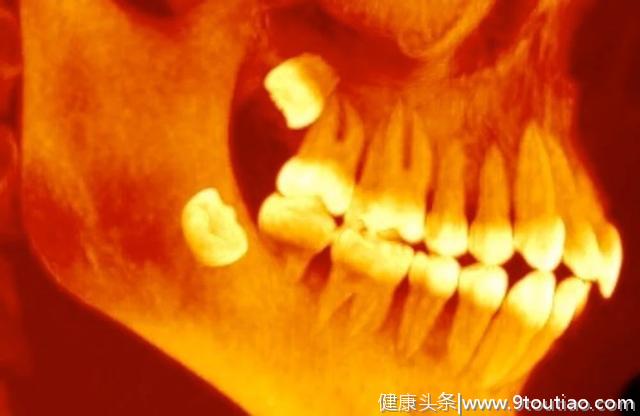 古人长智齿是为了吃更多猎物，今人长智齿则是侵蚀周围的牙齿