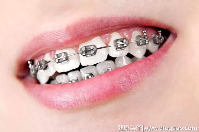 为什么戴牙套的朋友特别懂“护牙”？因为他们都懂怎样正确刷牙！