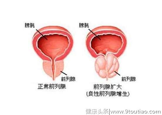 什么是前列腺增生？前列腺增生会不会变成前列腺癌？