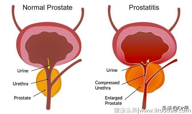 哪些人容易得前列腺炎，这篇文章告诉你答案