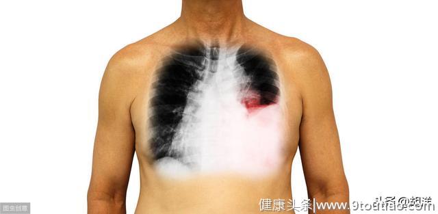 6类情况需要做肺穿刺诊断肺癌，6类人尽量避免做穿刺，有较大风险