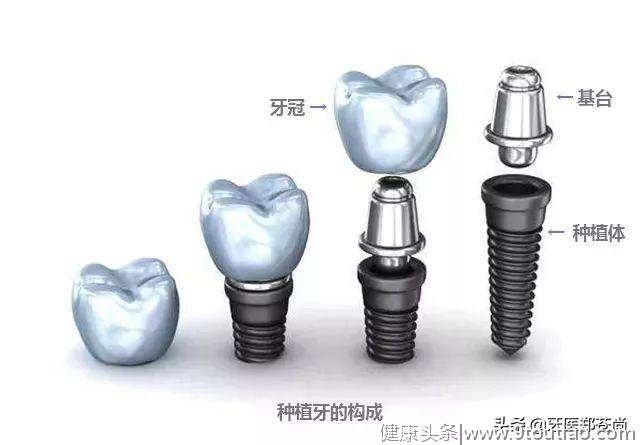 种植牙的材料是什么？