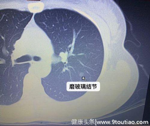 38岁女性有肺癌家族史，发现肺部结节，切除显示为腺癌
