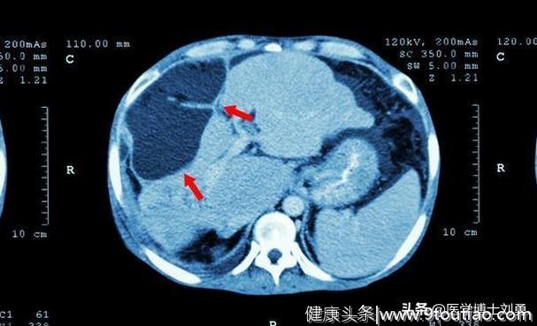 夫妻双双肝癌晚期，只因顿顿食2物，若你也一样，尽早查下肝功能