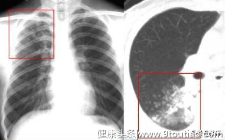 结核表现各不相同，有的像肺炎，有的像肺癌，有的查出来时已自愈