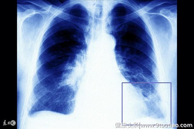 五大原因导致呼吸系统感染