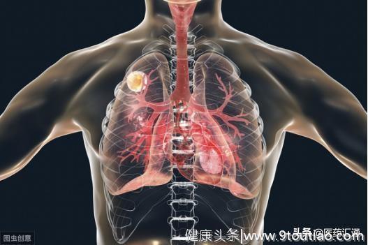 肺病多是“熏”出来的！提醒：这4种生活方式，会“熏”坏你的肺