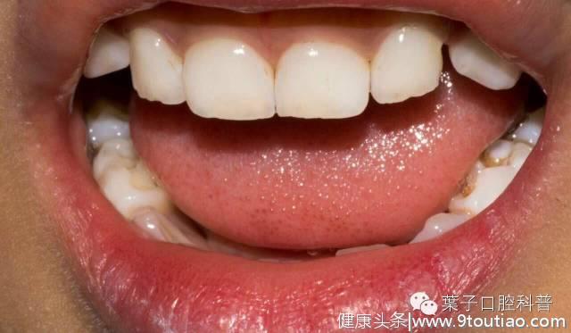 孩子牙菌斑很多，光靠刷牙也无法清除，该怎么办？