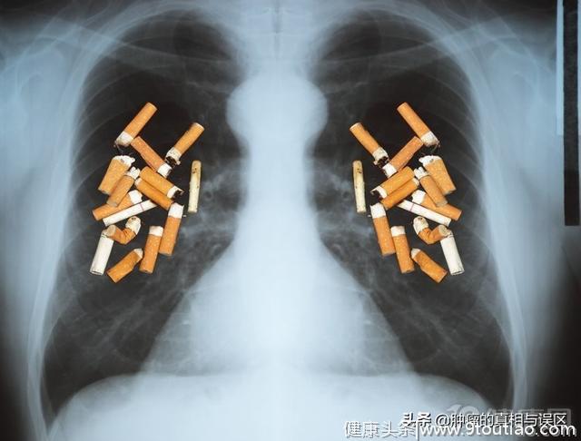 肺癌到了晚期，如何才能保住命？手术不是唯一方法