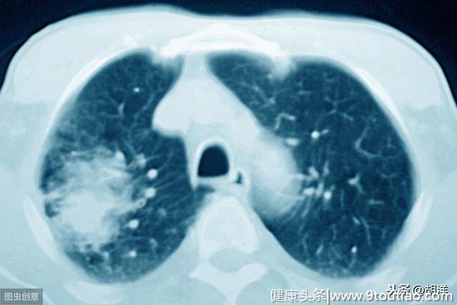被胸片坑了那么多年，现在终于意识到，能筛查到早期肺癌的唯有它