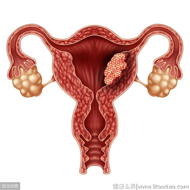 子宫内膜增生就会得癌？医生：这几类人千万不可大意