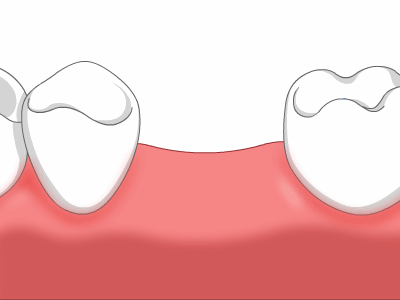 种植牙，一种没有年龄限制的口腔治疗法