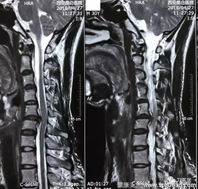 神经根型颈椎病保守治疗的比较