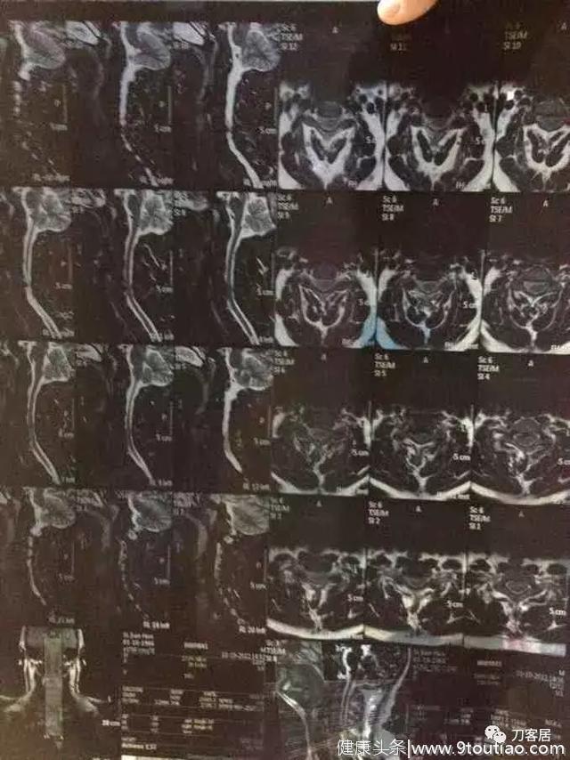 神经根型颈椎病保守治疗的比较