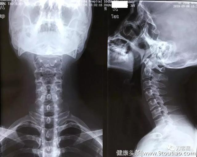 神经根型颈椎病保守治疗的比较