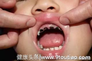 两岁宝宝满口牙齿全部坏掉，医生说出原因，全家人后悔不已！