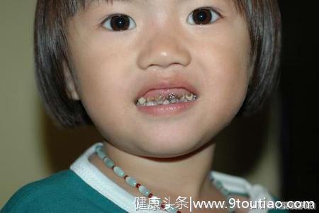 两岁宝宝满口牙齿全部坏掉，医生说出原因，全家人后悔不已！