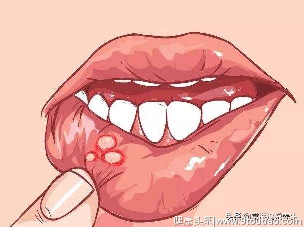 口腔总爱长溃疡？别再犯这3大错误习惯，5招减轻嘴巴疼痛！