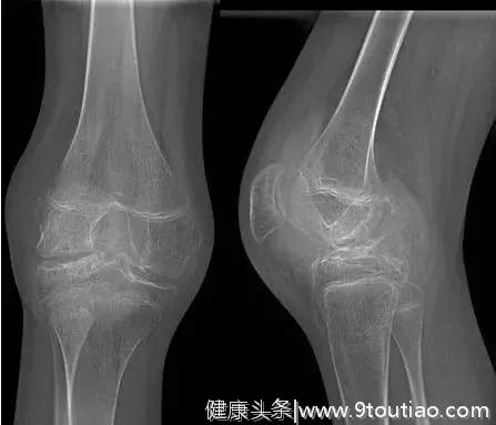 关节疼痛，是骨关节炎、风湿性关节炎还是类风湿性关节炎？