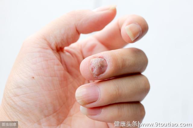 为什么那么多人喜欢咬指甲，咬指甲的5种危害，还会得口腔性病？